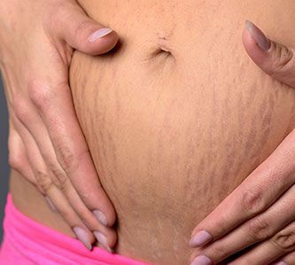 stretch marks